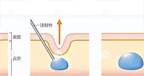 玻尿酸注射皮肤前后对比 玻尿酸注射皮肤前后对比