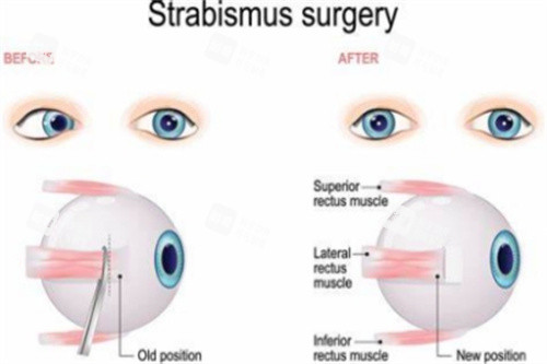 斜视眼球状况 斜视眼球状况