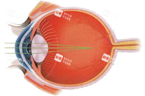 近视光线示意图 近视光线示意图