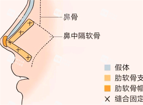 隆鼻形态 隆鼻形态