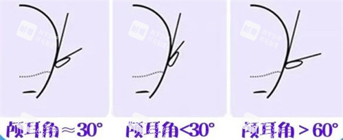不同颅耳角的区别