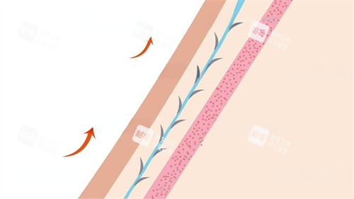 埋线原理动画演示图