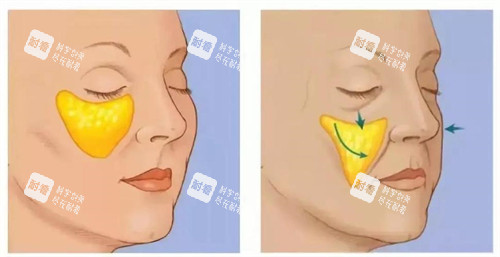 苹果肌下垂演示动画图
