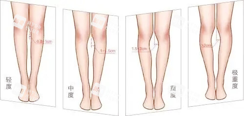 腿型矫正对比图