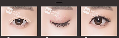 埋线双眼皮过程示意图