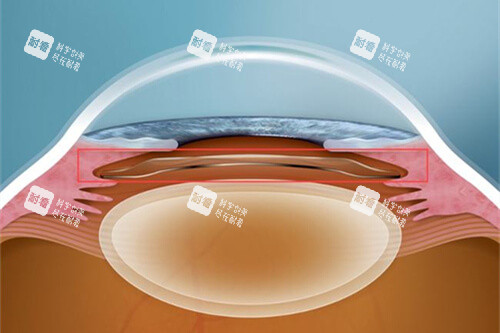 icl晶体植入眼睛漫画图 icl晶体植入眼睛漫画图