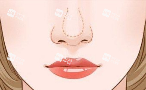 鼻小柱延长漫画图 鼻小柱延长漫画图