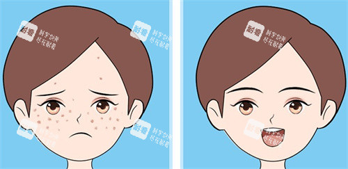 激光祛斑对比 激光祛斑对比