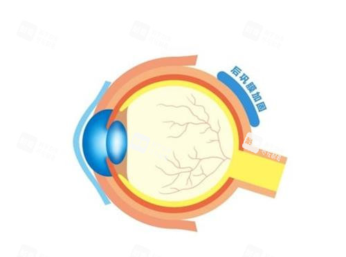 后巩膜加固的部位 后巩膜加固的部位