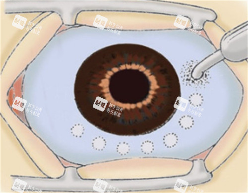 睫状体冷冻术手术过程图解
