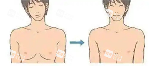 男性乳房发育吸脂后示意图