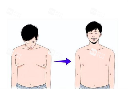 男性乳房肥大下垂