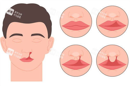 成人唇裂及唇腭裂 成人唇裂及唇腭裂