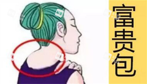 脖子富贵包卡通示意图