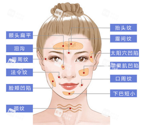 面部脂肪填充部位展示图