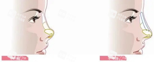 隆鼻前后对比图 隆鼻前后对比图
