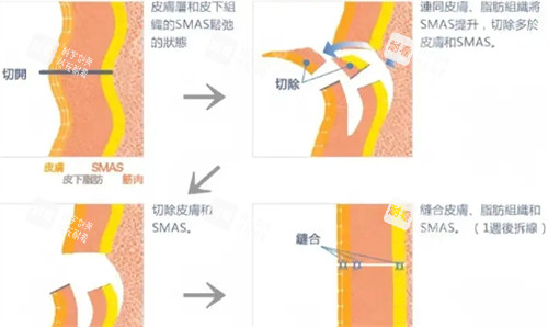 拉皮手术过程 拉皮手术过程