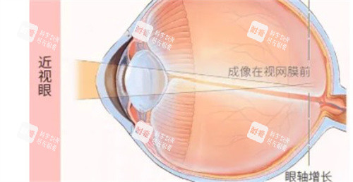 近视眼的成像 近视眼的成像