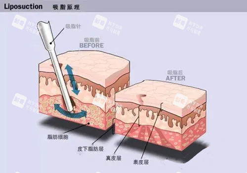 水动力吸脂手术原理动画图