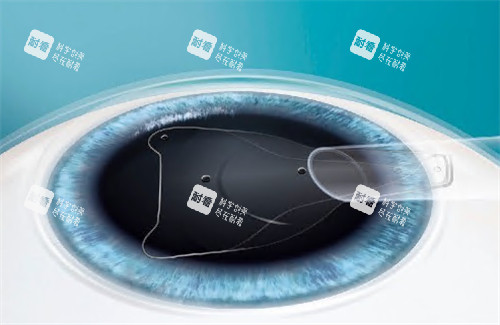 晶体植入手术过程图解 晶体植入手术过程图解