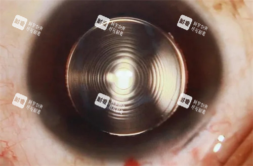 蔡司939人工晶体展示示意图