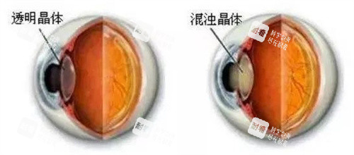 透明晶体和混浊晶体对比图