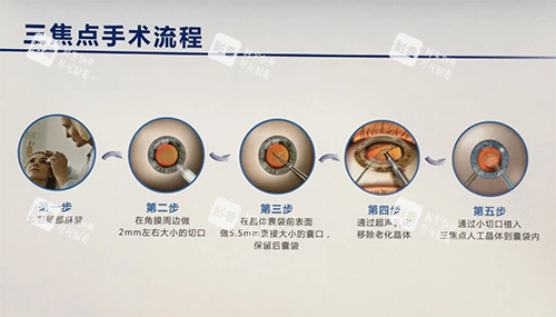 三焦点人工晶体手术方法步骤