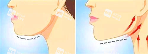 拉皮手术示意图 拉皮手术示意图