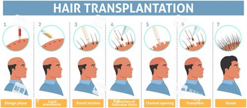 脱发星人必看！我在北京找高红侠医生植发，重获浓密秀发的神奇经历！