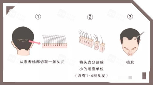 头发移植图示 头发移植图示