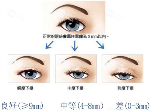 提上睑肌力量划分 提上睑肌力量划分
