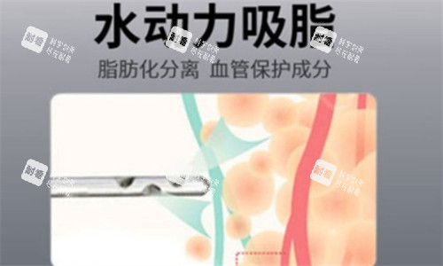 水动力吸脂 水动力吸脂