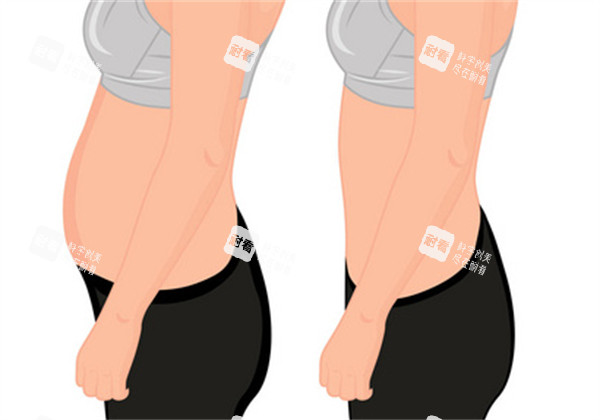 蜂腰闪瘦施术前后对比图 蜂腰闪瘦施术前后对比图