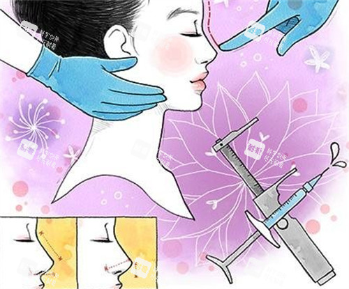 微晶瓷注射隆鼻前后对比 微晶瓷注射隆鼻前后对比