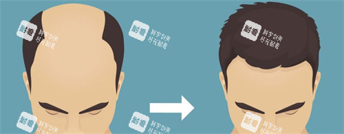 种发际线前后对比 种发际线前后对比