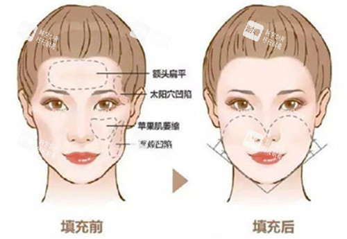 自体脂肪填充前后对比图 自体脂肪填充前后对比图