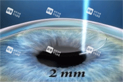 合肥沃瑞眼科真实体验：30年医师亲诊，我的全飞秒手术蜕变日记