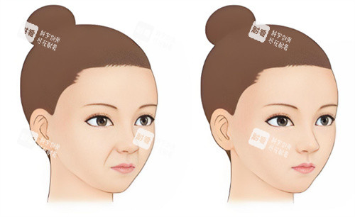 祛法令纹前后对比