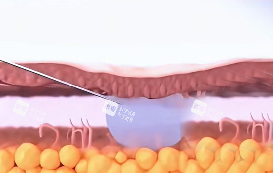 紧缩针填充私密位置照片 紧缩针填充私密位置照片