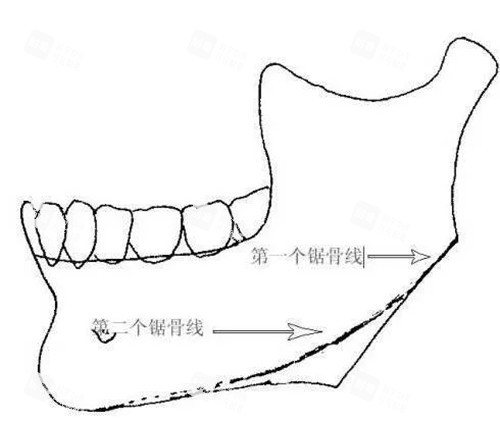 下颌骨截骨出现二次角示意图