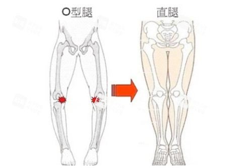 腿型矫正图对比