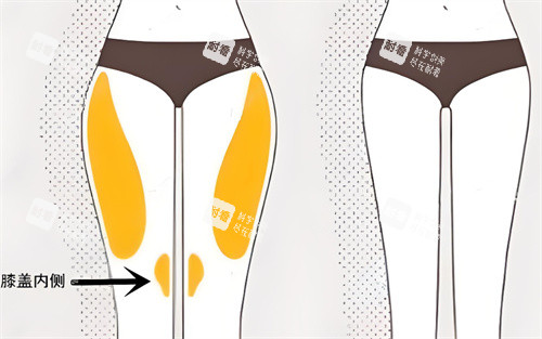 腿部吸脂前后对比