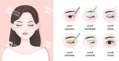 谁能告诉我上海周美兰修复双眼皮技术好不好？她做的双眼皮线条流畅度极高