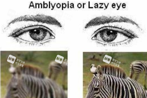 弱视视物对比图