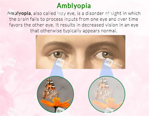 弱视和正常视野区别