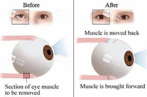 弱视手术前后对比图