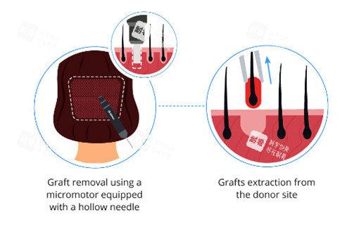 种植眉毛 种植眉毛