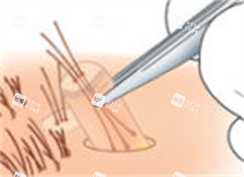 毛发移植的过程图解 毛发移植的过程图解