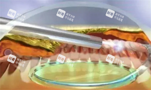 睫状体冷冻术手术步骤图解 睫状体冷冻术手术步骤图解