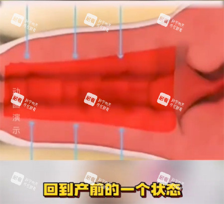 女性私密收紧针照片 女性私密收紧针照片